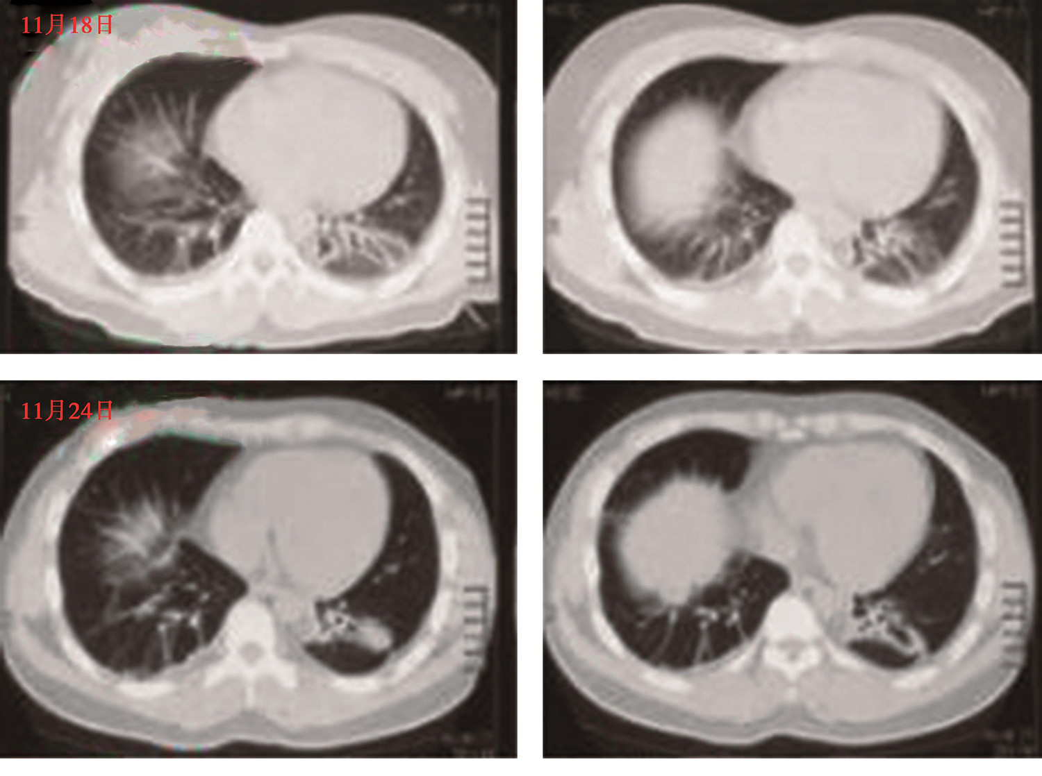 图2 肺部CT（12月3日与11月18日、11月24日肺部CT对比）（1）.jpg